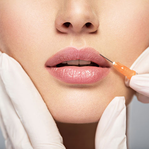 Lip Filling with Hyaluronic Acid