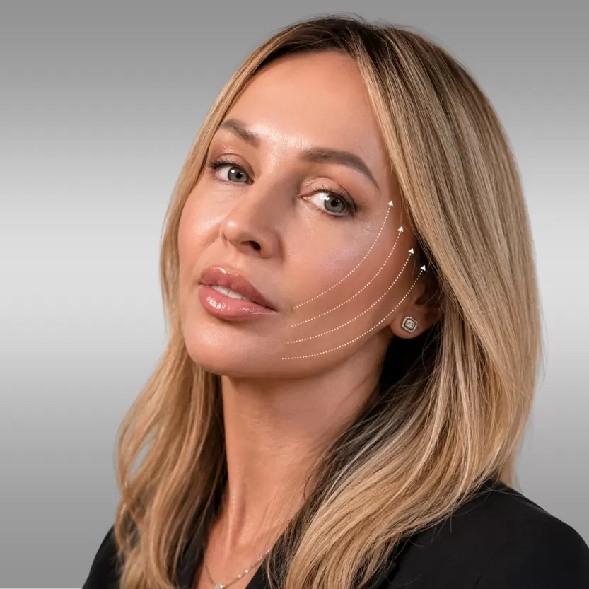 Thread lift facelift and thread lifting