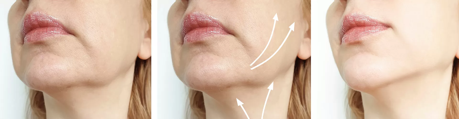 Definición de la línea mandibular